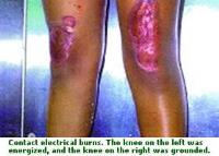 Example of high-voltage electrical shock injury